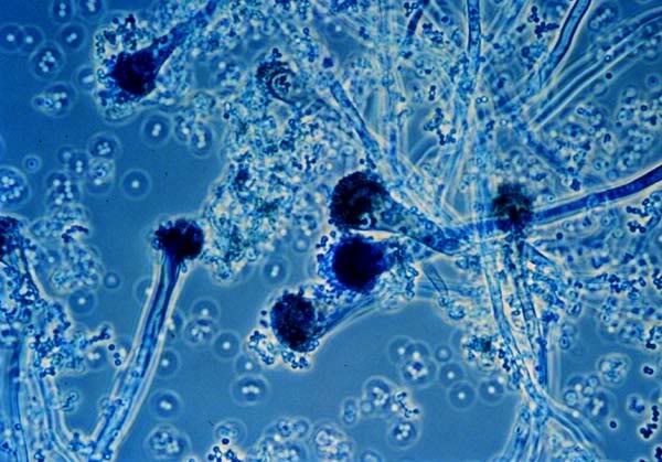 Nhiễm trùng nấm aspergillus - Hình ảnh minh họa
